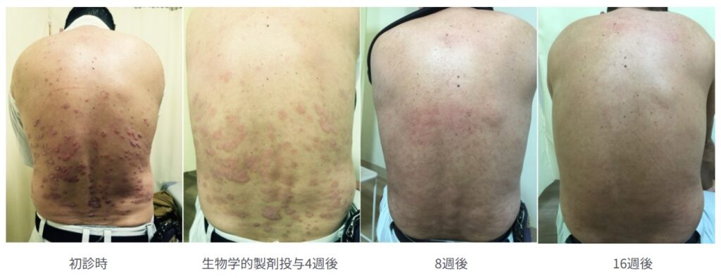 尋常性乾癬の治療症例